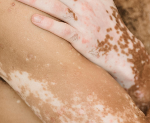 Pigmentation & Dark Spot Reduction